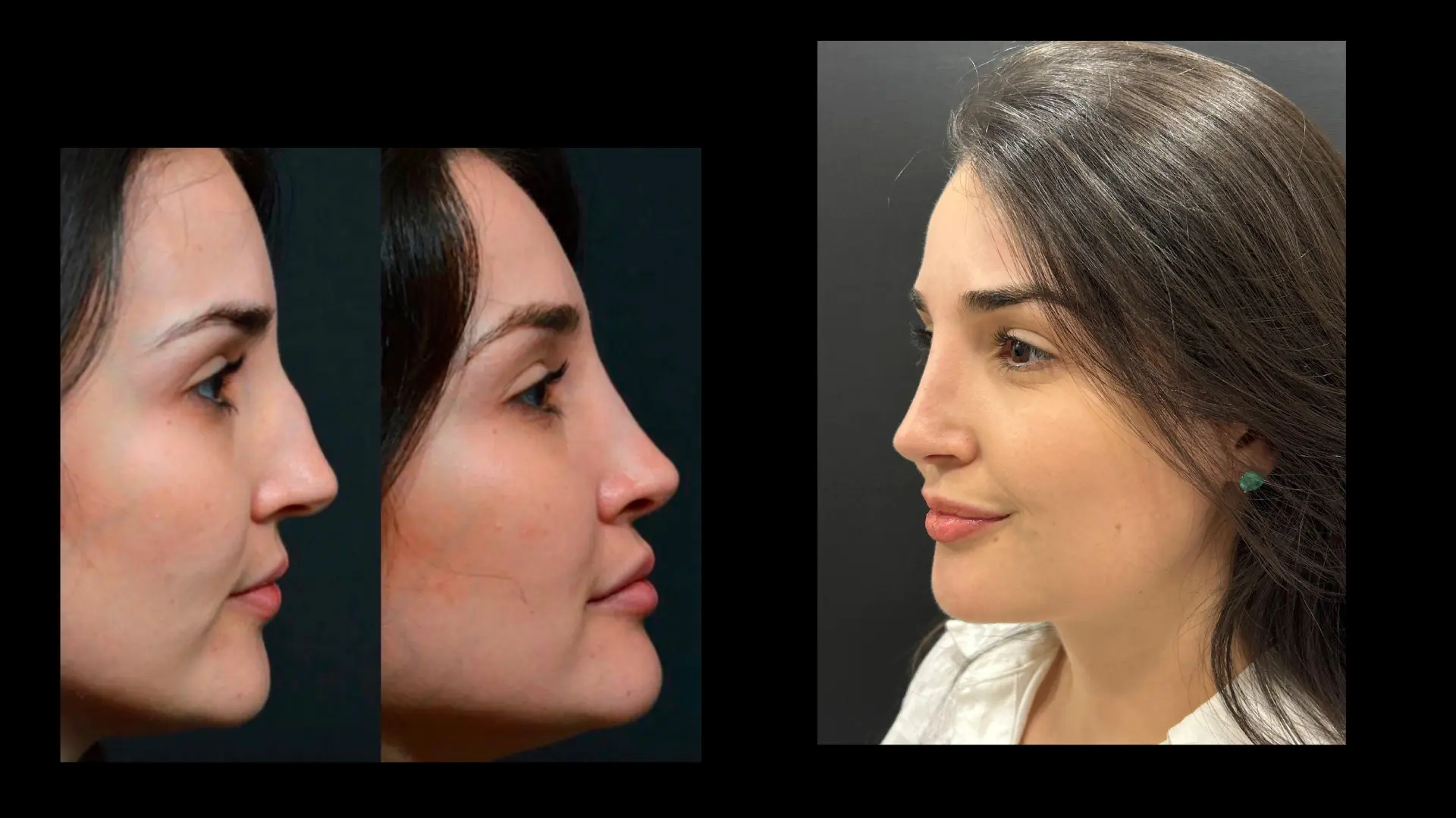 Resultado 6 de rinoplastia — antes e depois em vista de perfil