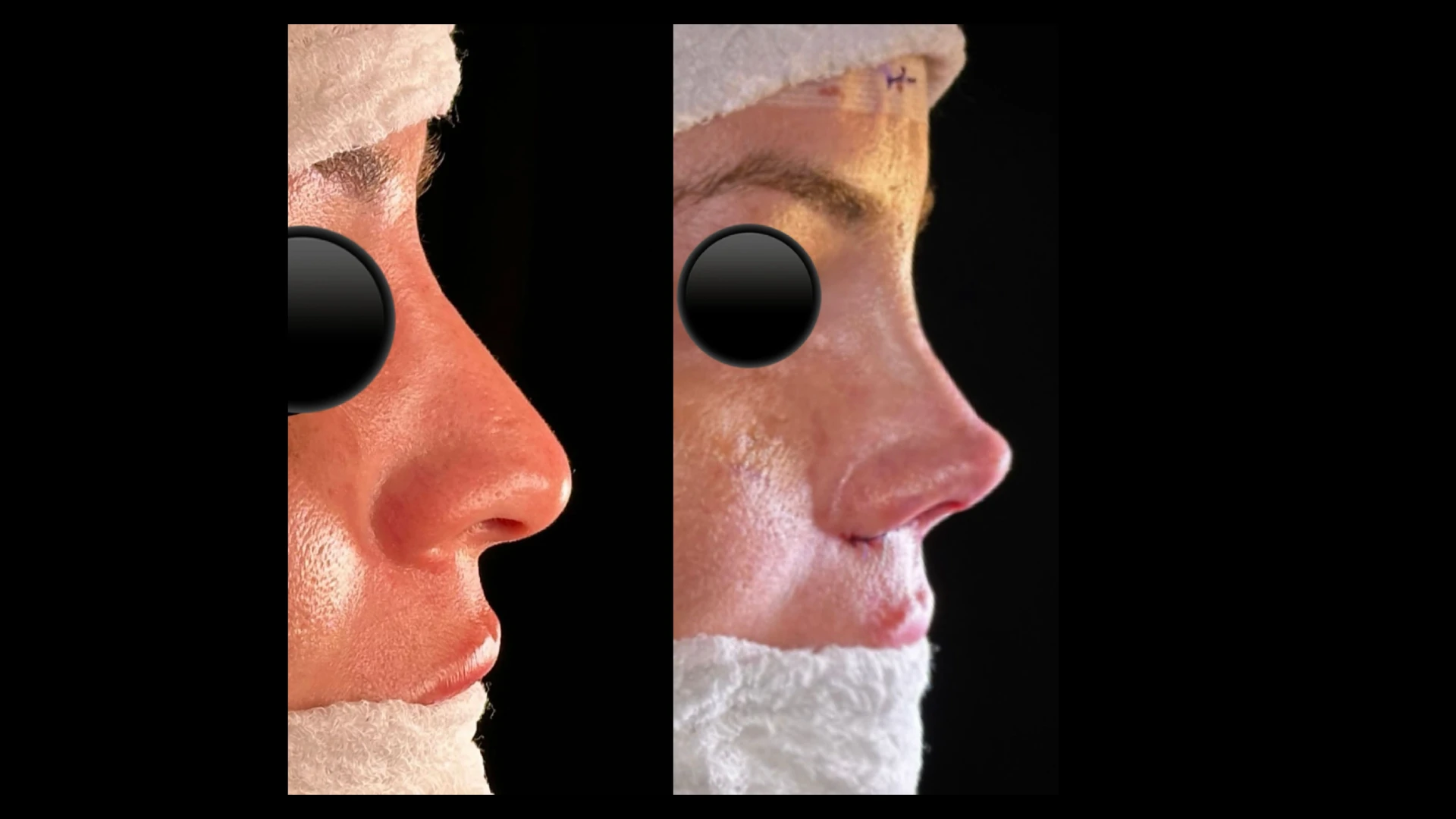 Resultado 5 de rinoplastia — antes e depois em vista de perfil