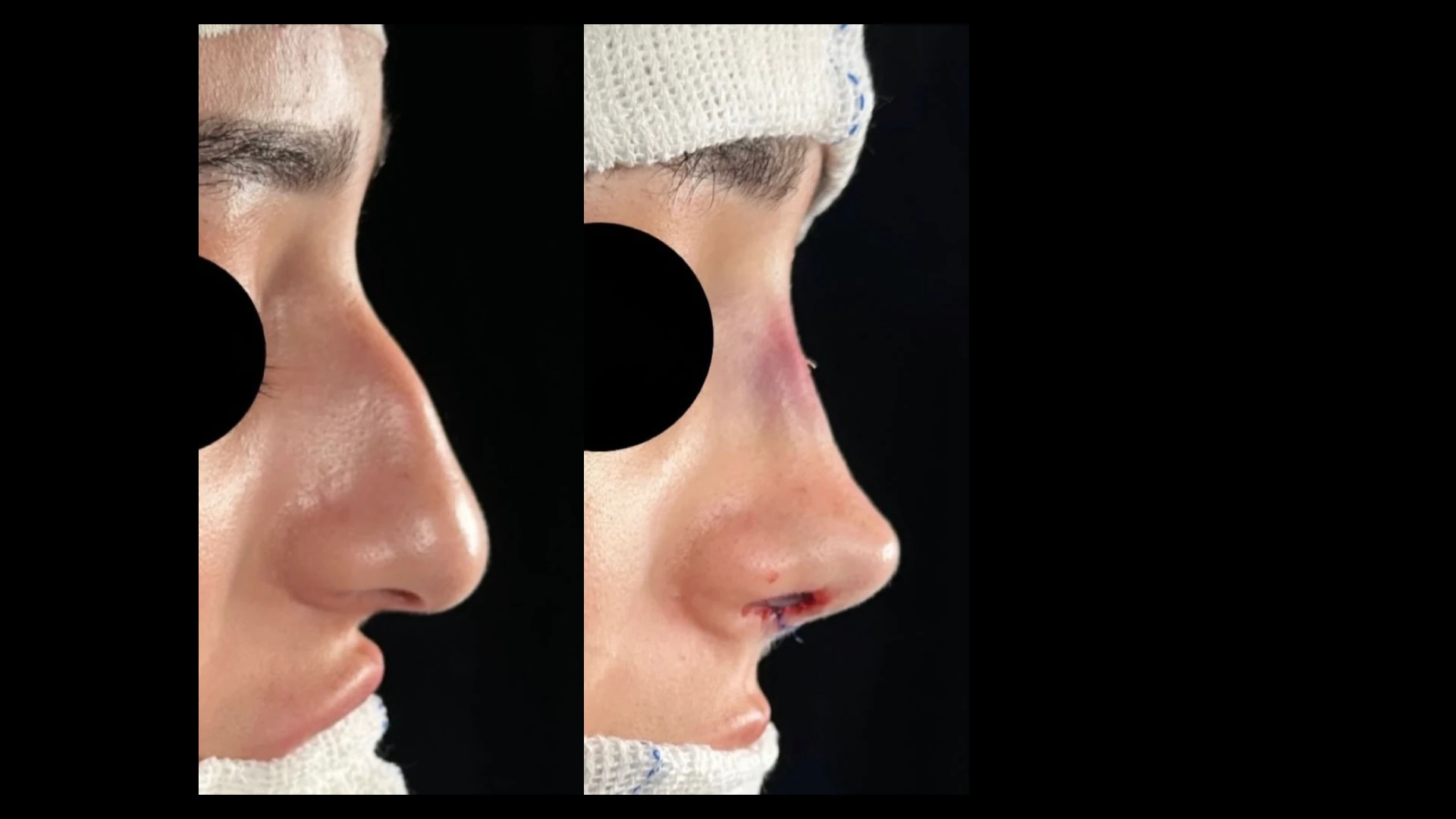Resultado 4 de rinoplastia — antes e depois em vista de perfil