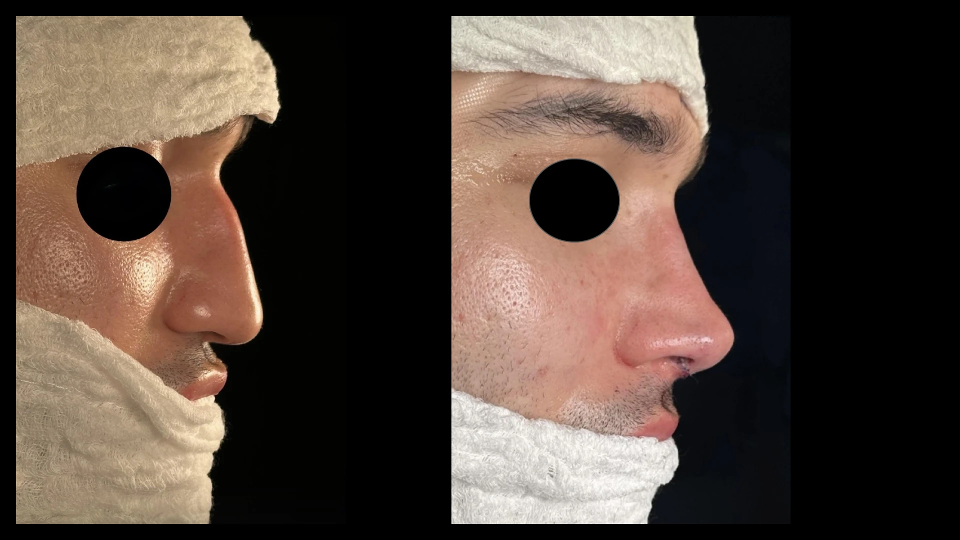 Resultado 8 de rinoplastia — antes e depois em vista de perfil