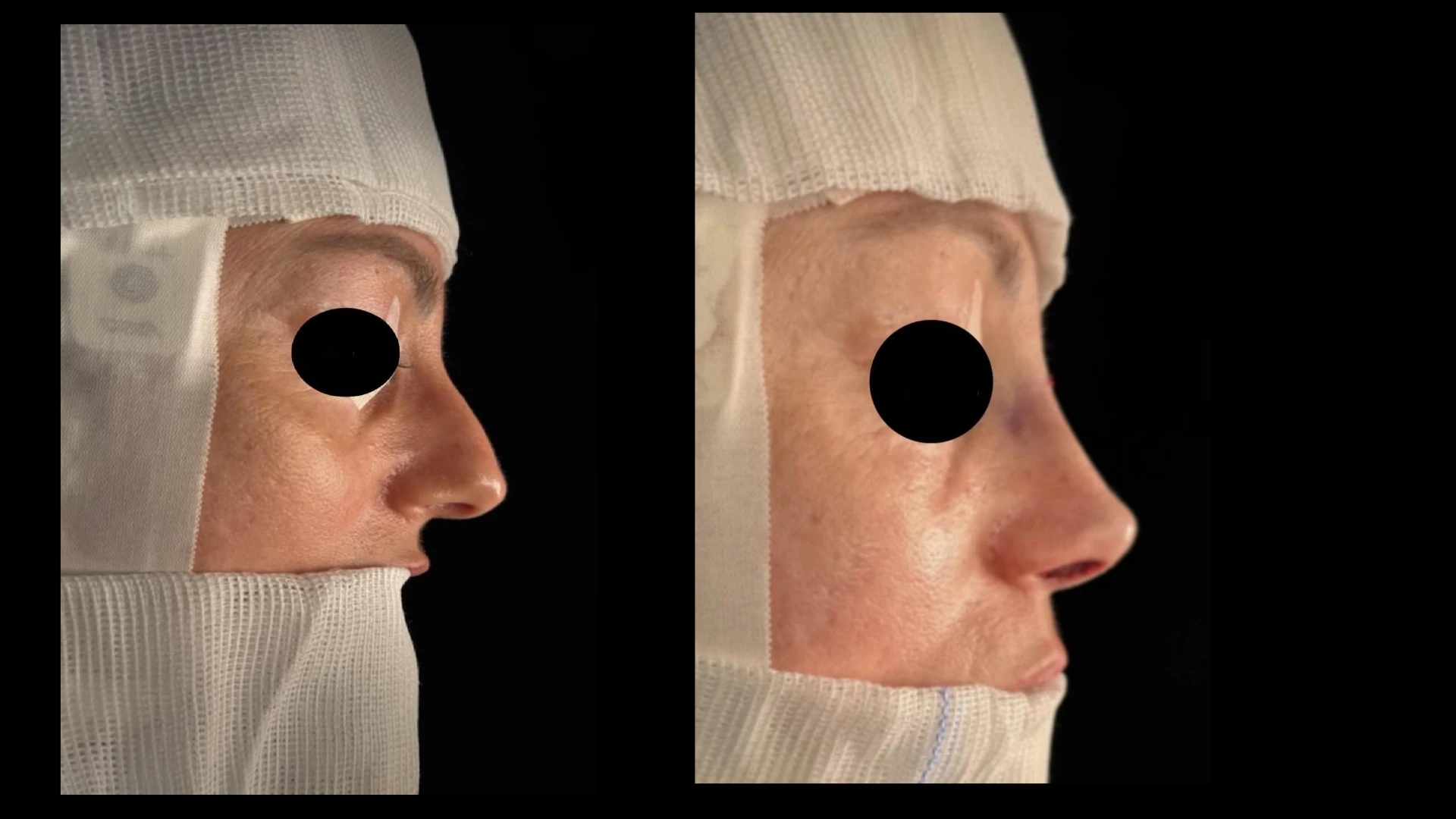 Resultado 2 de rinoplastia — antes e depois em vista de perfil