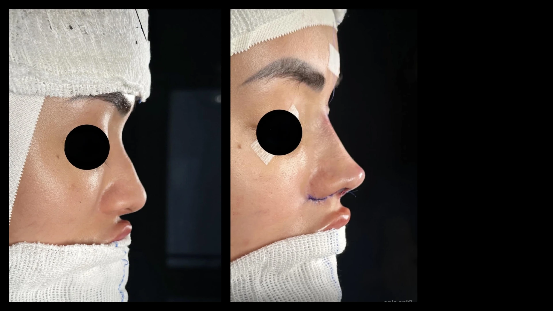 Resultado 1 de rinoplastia — antes e depois em vista de perfil