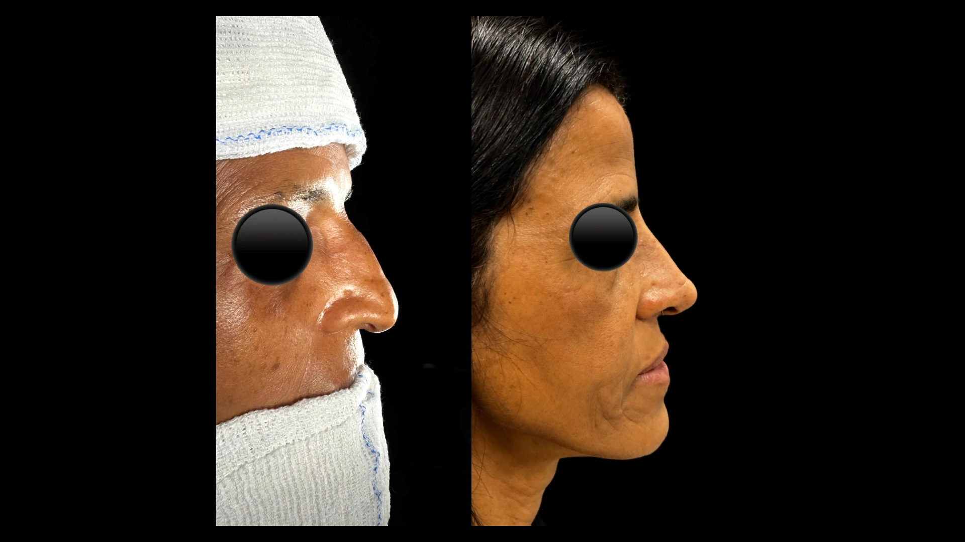 Resultado 3 de rinoplastia — antes e depois em vista de perfil