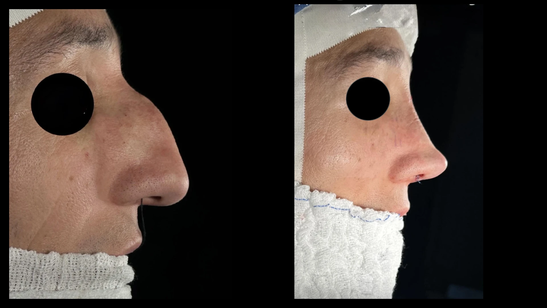 Resultado 7 de rinoplastia — antes e depois em vista de perfil